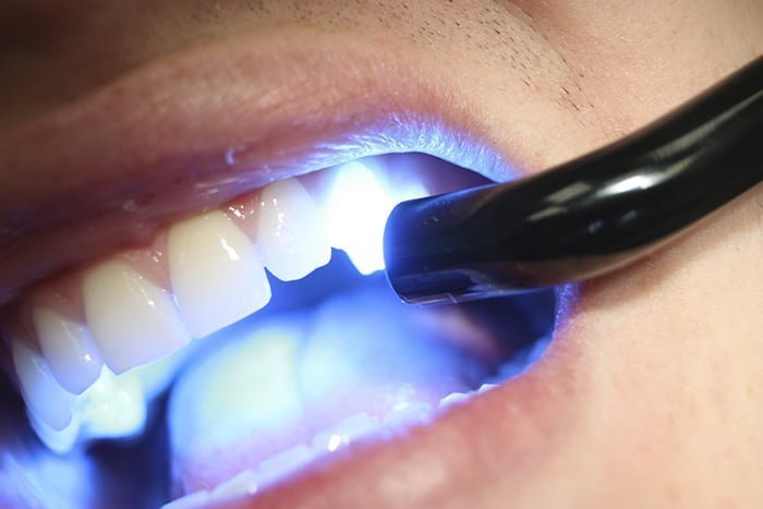 Clareamento dental a laser em destaque