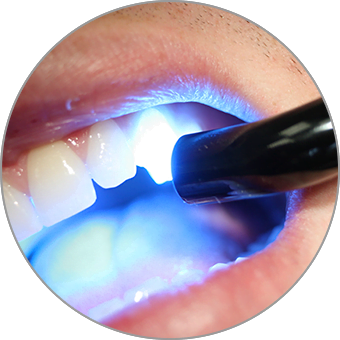 Clareamento Dental à Laser
